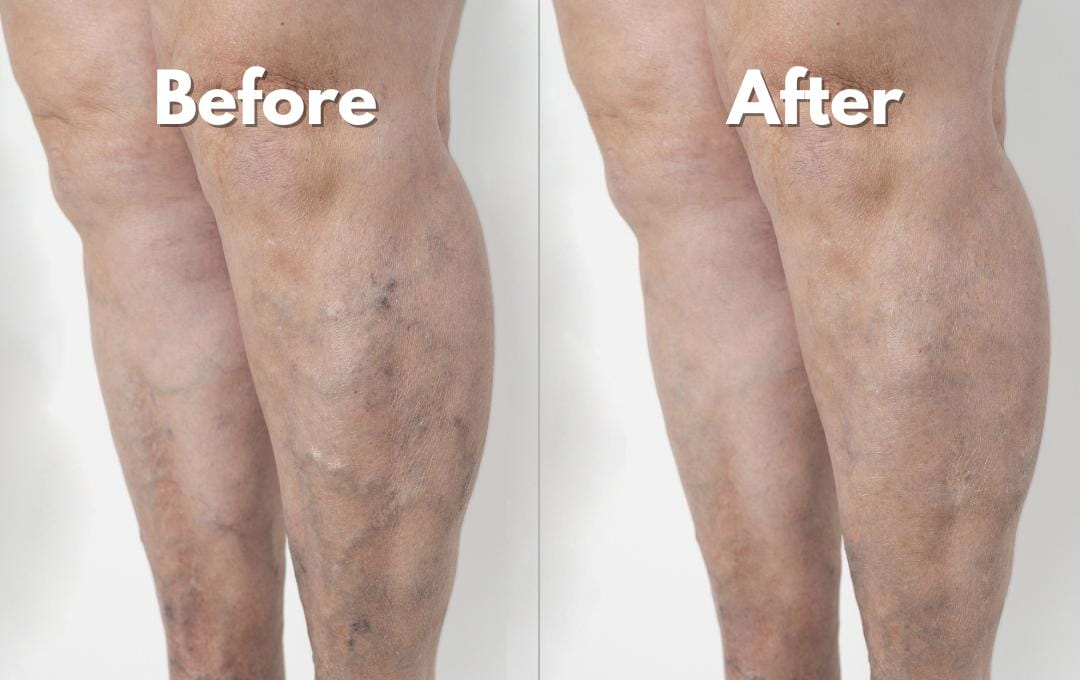 Varicose Vein Treatment Recovery 6 Before and after varicose vein treatment.