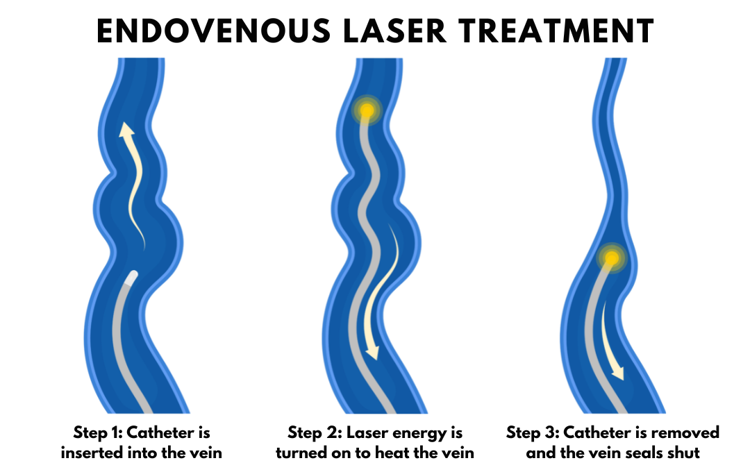Is Laser Treatment For Varicose Veins Safe? Here’s What Our Specialists Say 5 Graphic that shows how a laser treatment for varicose veins works.