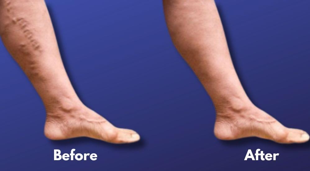 How Long Does It Take For Varicose Vein Treatment To Work? 6 How Long it Takes Varicose Veins to Work Results