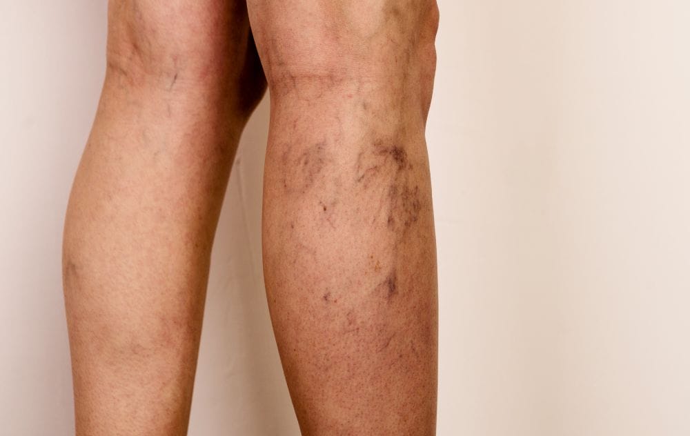 Normal Veins Vs Reticular Veins: Key Differences 6 Normal Veins vs Reticular Veins