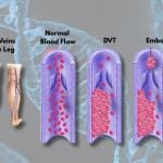 Is Deep Vein Thrombosis Genetic? Dvt Risk Factors Explained 5 Is Deep Vein Thrombosis (DVT) Genetic?