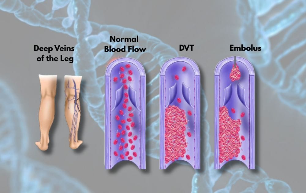 Is Deep Vein Thrombosis Genetic? DVT Risk Factors Explained
