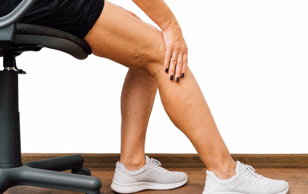Can You Get Varicose Veins From Working Out? 5 Woman sitting in an office chair brushes her hand over her varicose veins, which are above her right knee.
