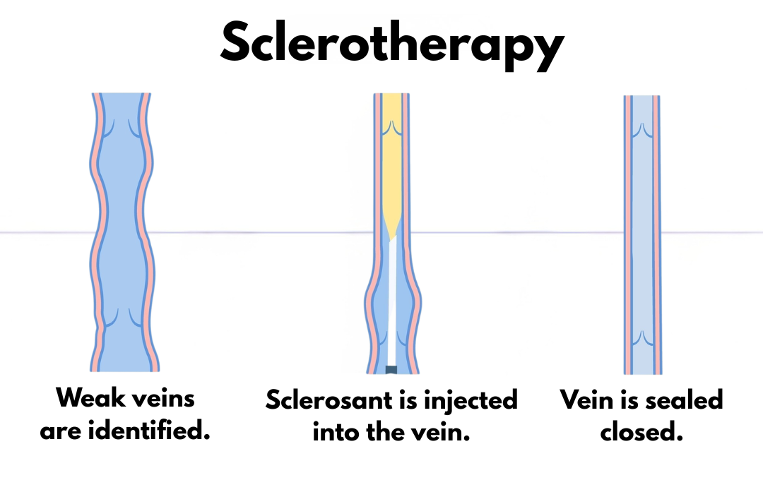 What Is Thread Vein Removal? 5 A diagram shows how sclerotherapy works. Sclerotherapy is a type of thread vein removal.