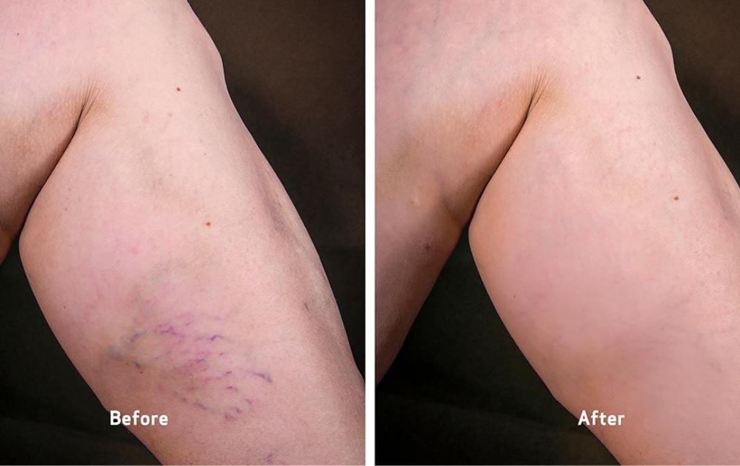 What Is Thread Vein Removal? 6 Real images of a patients legs before and after thread vein treatment.