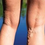 Varicose Veins Behind The Knees 14 Varicose veins on back of the knee of woman at lake