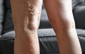 Varicose Veins Behind The Knees 6 Varicose Veins behind the knees