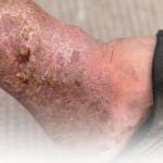 How To Heal A Venous Stasis Ulcer 9 A healing venous stasis ulcer