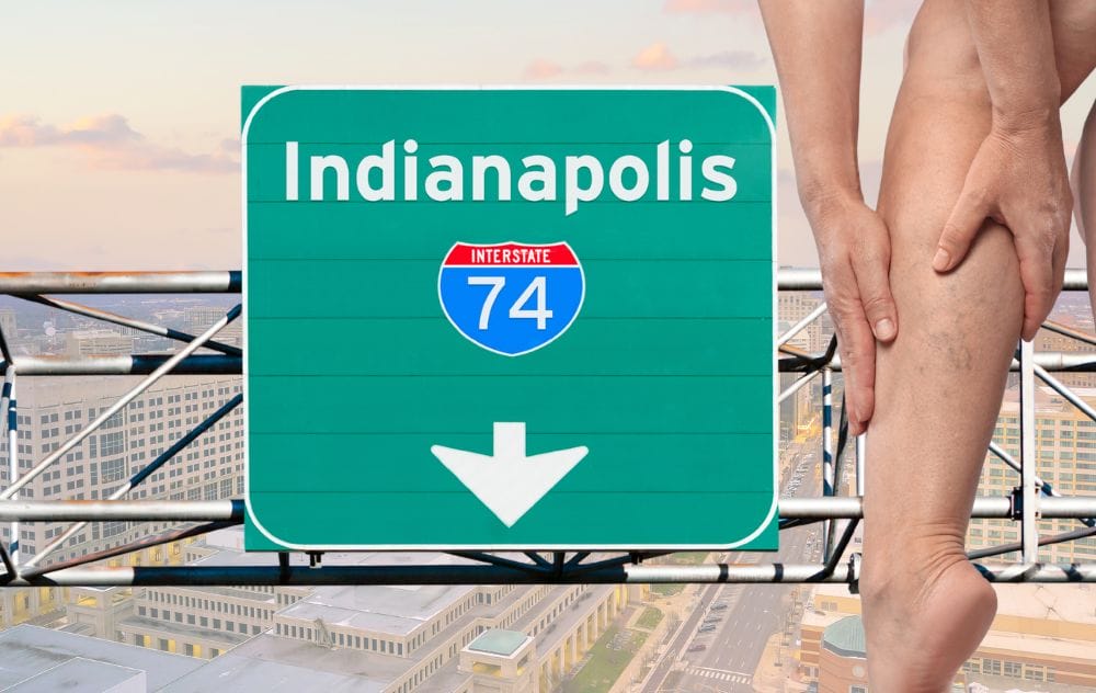 How To Find Vein Treatment In Indianapolis 4 Finding Vein Treatment in Indianapolis