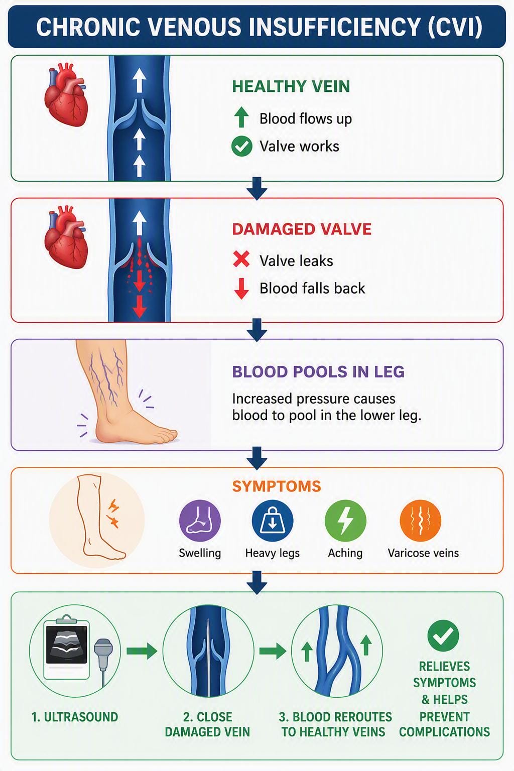 What Is The Most Common Vein Disease? 5 Diagram showing how vein valves fail and cause blood pooling in legs