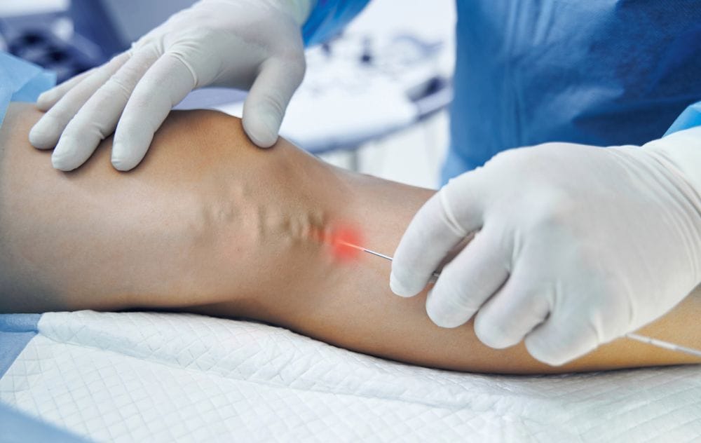 Endovenous Laser Vein Treatment (Evlt) 4 vein specialist performing ultrasound-guided EVLT catheter procedure