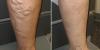 varicose veins on the legs