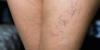 Why Your Veins Are So Visible