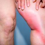 What Is Phlebitis? Causes, Symptoms &Amp; Treatment 8 what is phlebitis - how does it differ from deep vein thrombosis