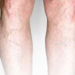 Are Varicose Veins Dangerous? 10 Looking at varicose veins and wondering if they are dangerous