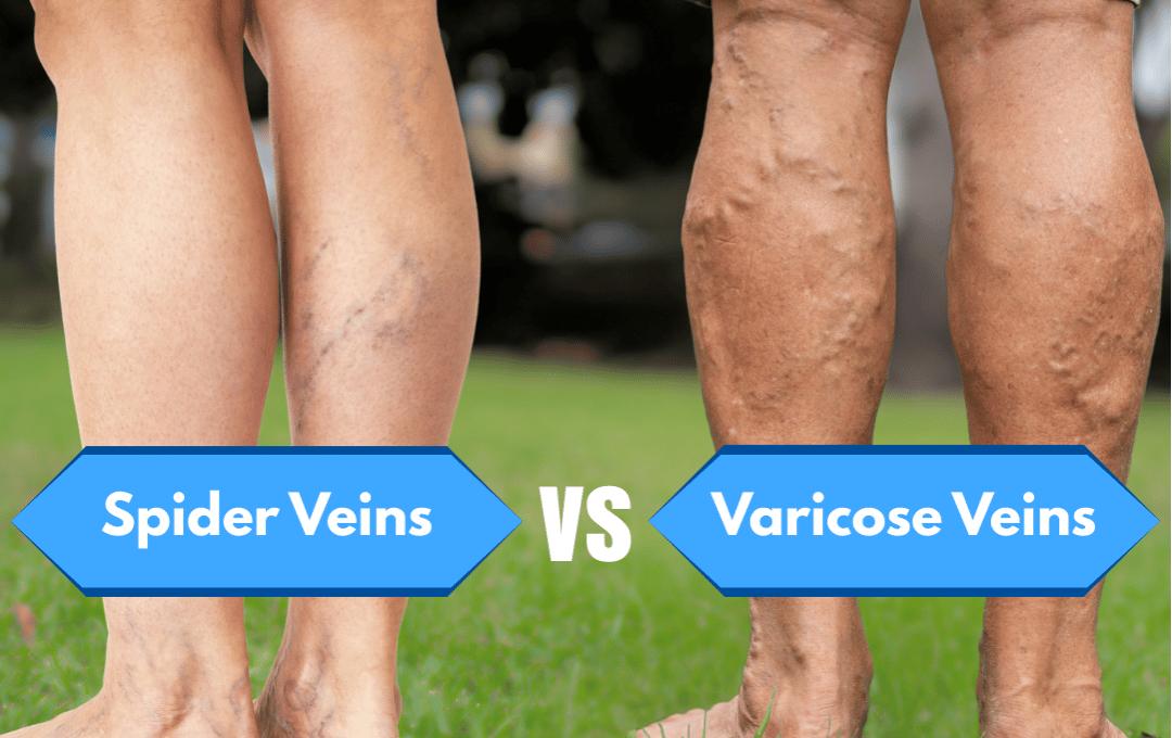 Varicose Veins Vs. Spider Veins 4 Spider Veins and Varicose Veins 1