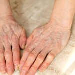 Veiny Hands: Common Causes And When To See A Specialist 7 Visible veins on hands