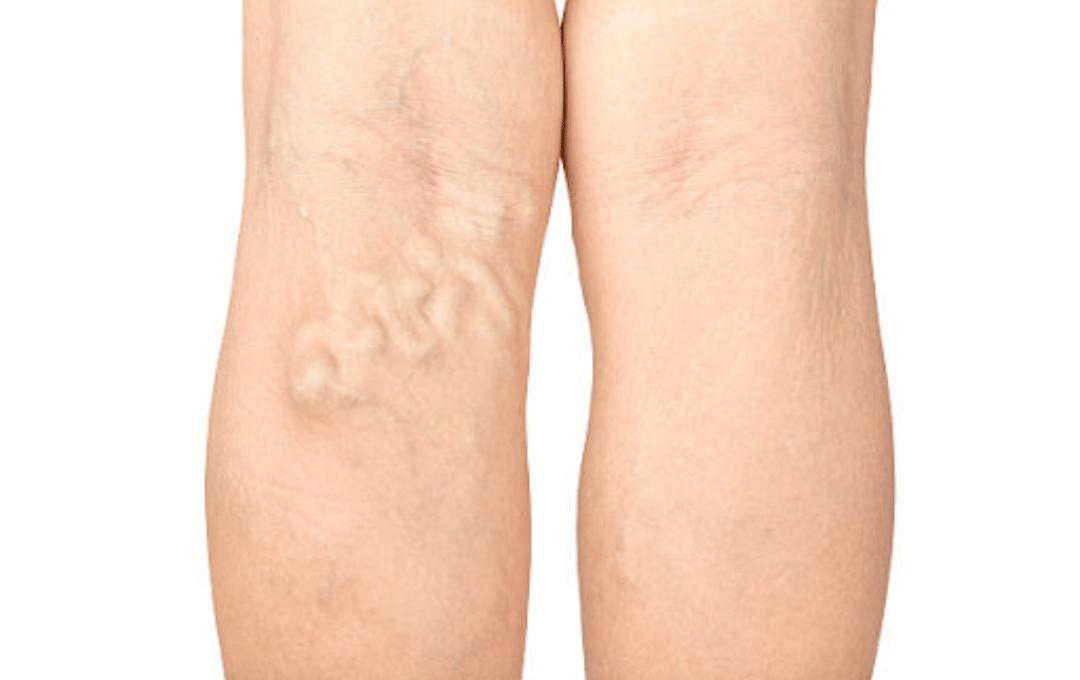 Symptoms Of Early-Stage Deep Vein Thrombosis (Dvt) In The Leg 4 8 Early Signs of Deep Vein Thrombosis (DVT)