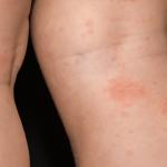 Understanding Varicose Eczema: Causes, Symptoms, And Treatment 8 How Does Varicose Eczema Develop Causes, Symptoms & Treatment