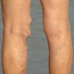 When To Worry About Varicose Veins 9 When to Worry About Varicose Veins