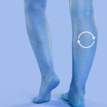 Can You Reverse Chronic Venous Insufficiency? 11 Can You Reverse Chronic Venous Insufficiency