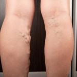 Do Varicose Veins Mean I Have Vein Disease? 10 If I Have Varicose Veins, Do I Have Vein Disease?