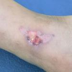 What Are The Venous Stasis Ulcer Stages? 11 Venous Stasis Ulcer Stages