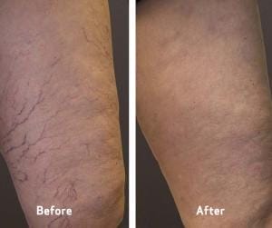 Before And After 9 Spider Vein Treatment: Before and After