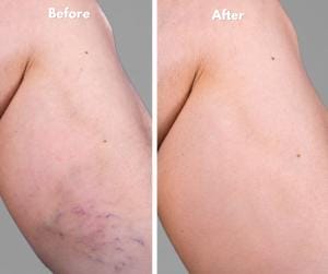 Before And After 12 Sclerotherapy: Before and After