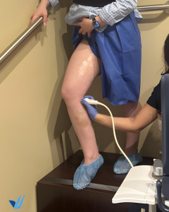 Varicose Vein Treatment 4 vein treatment ultrasound