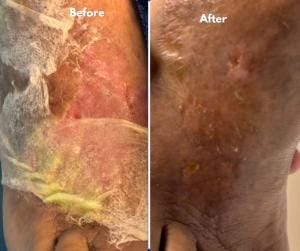 Before And After 10 Leg Ulcer: Before and After